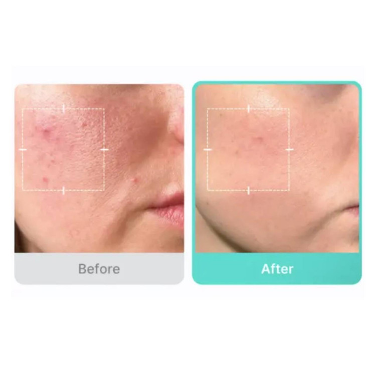 سرم آزلائیک اسید مدیکوب ضدقرمزی و تسکین دهنده